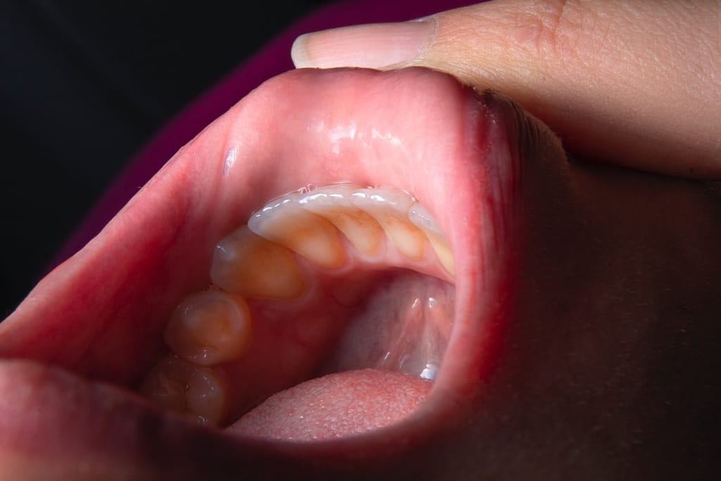 Untreated Cavities between Teeth